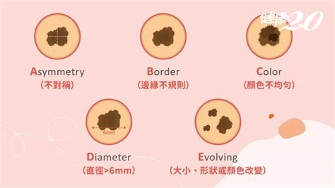 身體 痣|是痣還是瘤？黑色素瘤的類型、症狀與治療